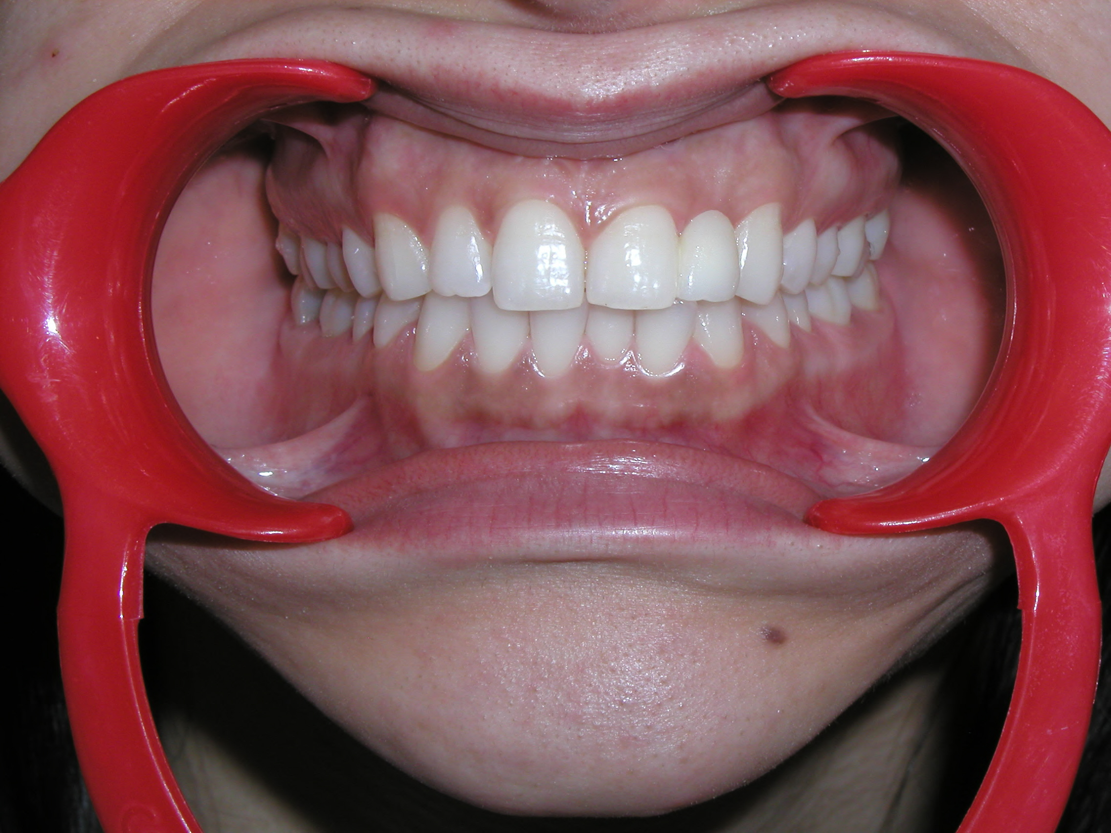 Zahnkorrektur 3